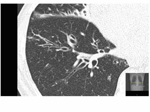 C A B KUVA 2. HRTT bronkiektasiapotilaan keuhkoista. Päälöydökset (A C). A) Keuhkoputkien laajenemat (keuhkoputken läpimitta suurempi kuin viereisen valtimon).