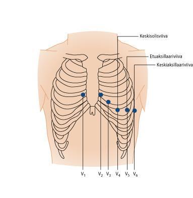 16 KUVA 2. Wilsonin rintakytkennät (Mäkijärvi 2008, 134) 5.2.2 Tulkinta Ennen tarkempaa tulkintaa on tärkeä tarkistaa, että EKG:ssa on potilaan nimi, henkilötunnus, tutkimusaika ja tutkimuspaikka.