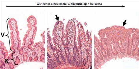 11 2.3.2 Koepala Ohutsuolesta otettua koepalaa on pidetty pitkään ainoana varmana keliakian diagnosointimenetelmänä, vaikka siinäkin on haasteensa.