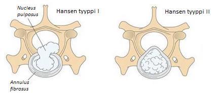 Kuva 4. Välilevytyrän tyypit: Hansen tyyppi I ja Hansen tyyppi II. Kuva muokattu lähteestä Hermanson 20