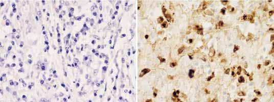 A B Kuva 3. Immunoglobuliini G4:ään liittyvä kolangiitti. A) Runsas plasmasolukertymä (hematoksyliini-eosiinivärjäys). B) IgG4-positiivisia plasmasoluja immunohistokemiallisesti värjättynä.