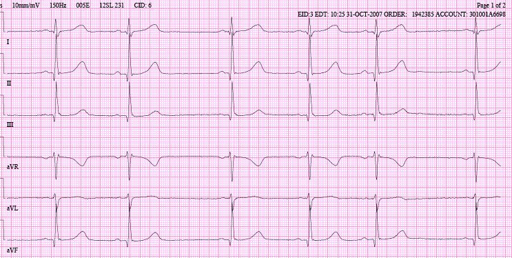 Kirjallisuutta 1 Dubin AM. Screening ECGs for young competitive athletes: it is complicated. Curr Opin Pediatr 2015;27:604 8. 2 Aro A, Parikka H. EKGpoikkeavuuksien kliininen merkitys.