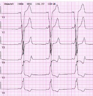 14-vuotiaalta pojalta tutkittiin EKG äidillä todetun pitkä QT -oireyhtymän vuoksi. EKG:n automaattianalyysi laskee virheellisesti korjatuksi QT-ajaksi 410 ms.