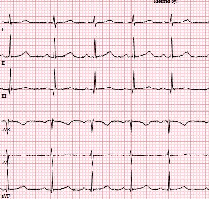 Kuva 5. 4-vuotiaan lapsen normaali (A) ja poikkeava EKG (B). A. Normaalissa EKG:ssä akseli on alas vasealle (kytkentöjen I ja avf R/S-heilahdukset positiiviset).