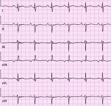 Kuva 6. Vasean kaion hypertrofia. 7-vuotiaalta tytöltä on tutkittu EKG suvussa esiintyvän hypertrofisen kardiomyopatian vuoksi.