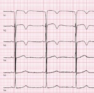 Kawasakin taudin tai sepelvaltimopoikkeavuuden ai- heuttama infarkti). Syvät Q-aallot vasealla lateraalisesti liittyvät myös vasean kaion hypertrofiaan.