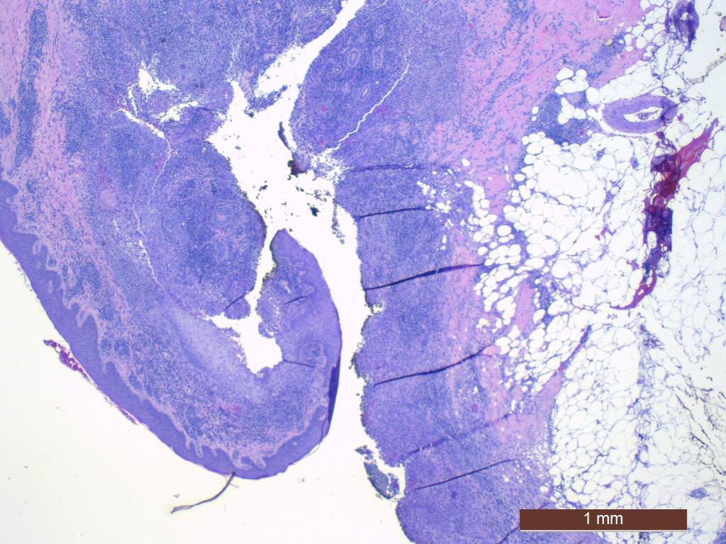 PYODERMA