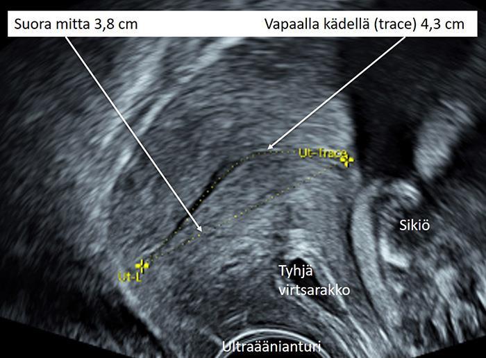 Käypä hoito -suositus 4 (27) [kuva 1b]=Kohdunkaulakanavan pituuden mittaaminen vapaalla kädellä Maija-Riitta Ordén 31.5.