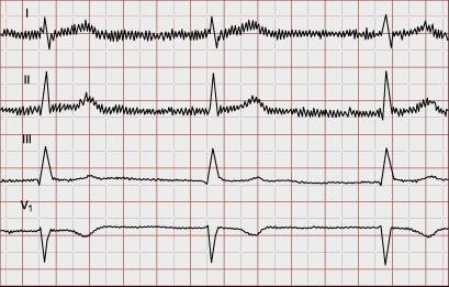 12 Kuva 3: Vaihtovirtahäiriön aiheuttama lukukelvoton käyrä Lähde: Mäkijärvi 2005 EKG-rekisteröinnin ottajan tekemät mahdolliset virheet ovat yleisiä virhelähteiden aiheuttajia.