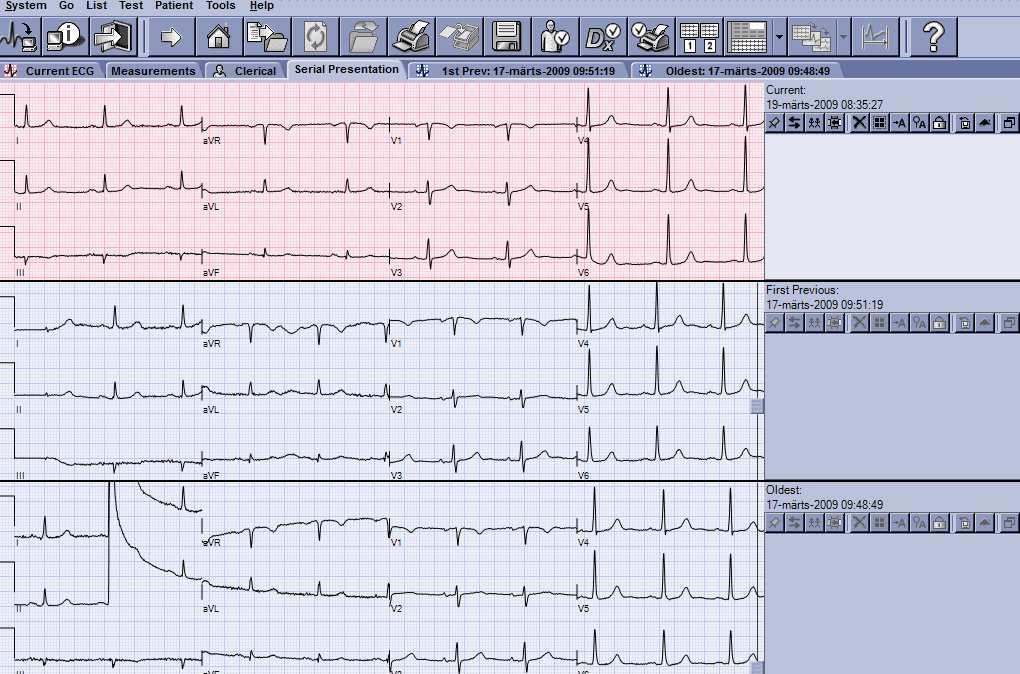 klassikaline EKG vaade MUSE kliendi tarkvara