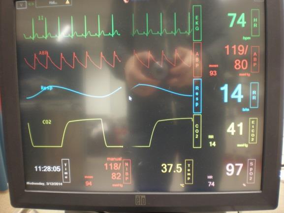 Liite 3 28(33) Kuva6 ARVIOINTI ARVIOINTI Kertoja: Intubaation aikana avustaja tarkkailee potilasta ja monitoroiduista elintoiminnoista etenkin happisaturaatiota ja ekg-käyrää. Kuva7 Tekstiruutu!