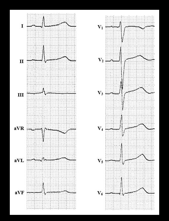 32 KUVA 10. Normaali EKG (Vuorimaa & Rantala 2017) 7.2 EKG:n systemaattinen tulkinta Taulukossa 2 on esitetty EKG:n systemaattisen tulkinnan vaiheet.