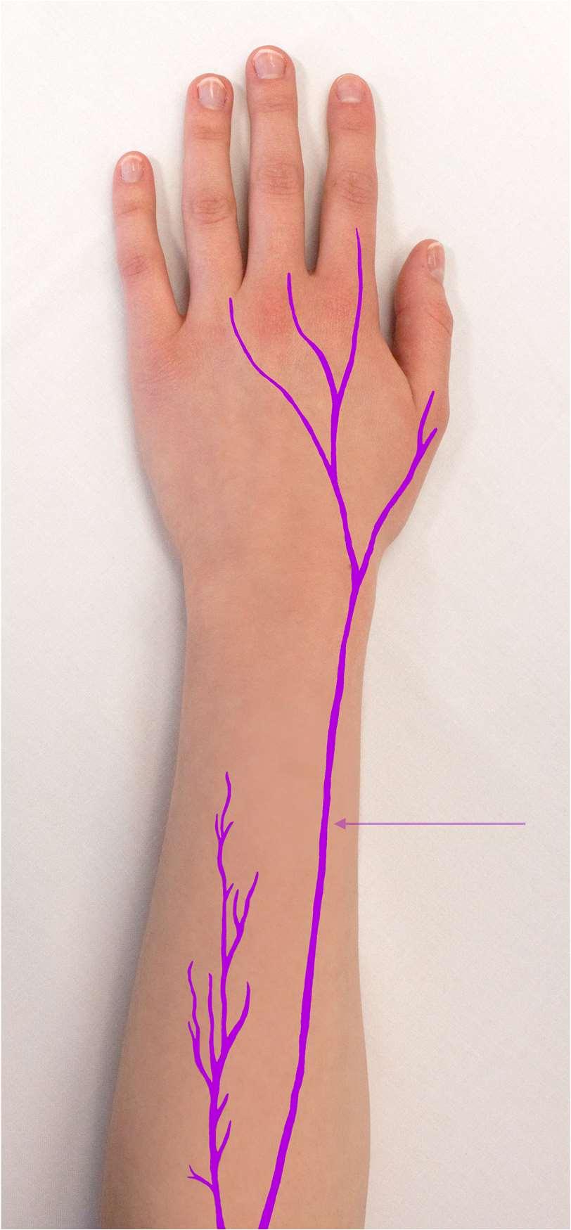 22 6.1 Yleisimmin mitattavat hermot Neurografiassa yleisimmin mitattavia yläraajojen hermoja ovat kyynärhermo (n. ulnaris), keskihermo (n. medianus) sekä värttinähermo (n.