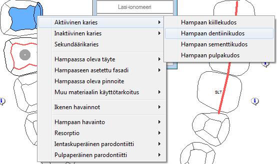 Valitse hampaan pinnat. Pinta muuttuu siniseksi kun se on valittu. 3.