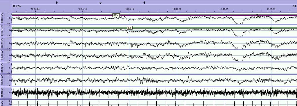 2 x EOG 4 x EEG 2 x EMG