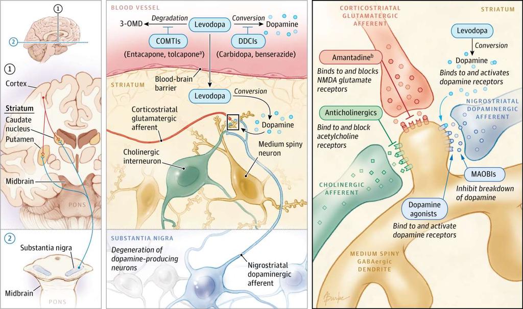 Parkinsonin