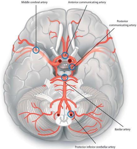 Kuva 1. Tavallisimmin aneurysmat kehittyvät Circulus Williksen valtimoiden haarautumiskohtiin kallonpohjassa. Kuva: Van Gijn J.