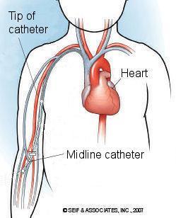 Midline-katetrin aiheet Käytetään yleensä 6 14 päivää kestävään suonensisäiseen hoitoon Asettamisella pyritään välttämään