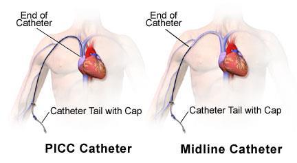 Määritelmiä PICC (Periferally Inserted Central Catheter) perifeerisesti (olkavarren laskimon kautta) asetettava
