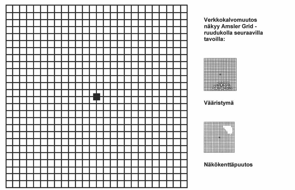 LIITTEET 4 AMSLER GRID -RUUDUKKO Verkkokalvomuutos näkyy Amsler Grid -ruudukolla seuraavilla tavoilla: Vääristymä Näkökenttäpuutos Katso ruudukon keskellä olevaa pistettä yhdellä silmällä (toinen