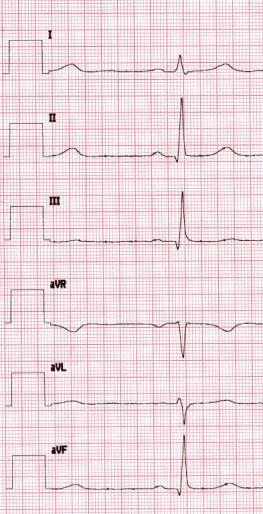 Liite 3: EKG-virheet Raajaelektrodien virheet 1 Normaali EKG EKG, 12