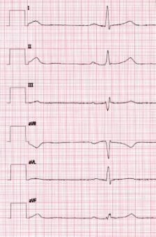 Liite 3: EKG-virheet Raajaelektrodien virheet 2 Normaali EKG EKG, 12 kytkentää