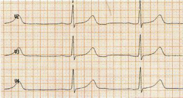 Liite 3: EKG-virheet Muut EKG-virheet Elektrodien irtoaminen tai kontaktihäiriö kytkentään piirtyy suoraa viivaa EKG, 12 kytkentää levossa ja EKG, 15