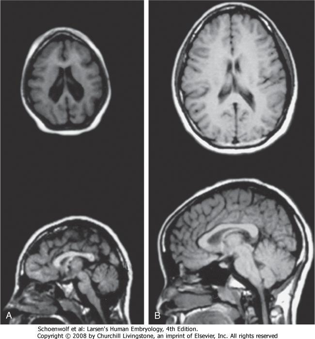 Mikrokefalia ASPM (ABNORMAL SPINDLE-LIKE MICROCEPHALY ASSOCIATED), banaanikärpäsen Abnormal spindlegeenin homologi, on useimmin yleisimmän autosomaalisen