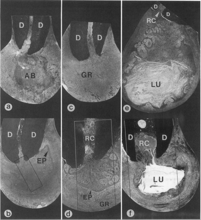 16 4.2 Histopatologia Histopatologisesti apikaalinen parodontiitti voidaan luokitella absessiksi, granuloomaksi tai kystaksi (kuva 4). (33) KUVA 4 Apikaalisen parodontiitin histopatologia.