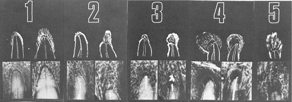 20 KUVA 6 Periapikaalinen indeksi. 1. normaali periapikaalinen rakenne, 2. pieniä muutoksia luun rakenteessa, 3. muutoksia luun rakenteessa sekä mineraalikatoa, 4.