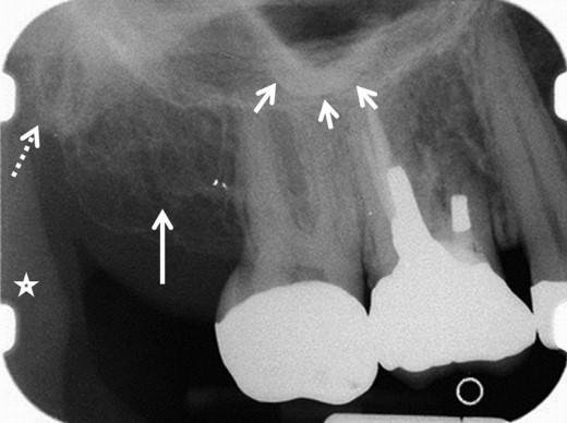 24 KUVA 8 Periapikaalinen röntgenkuva yläleuan molaarialueelta.