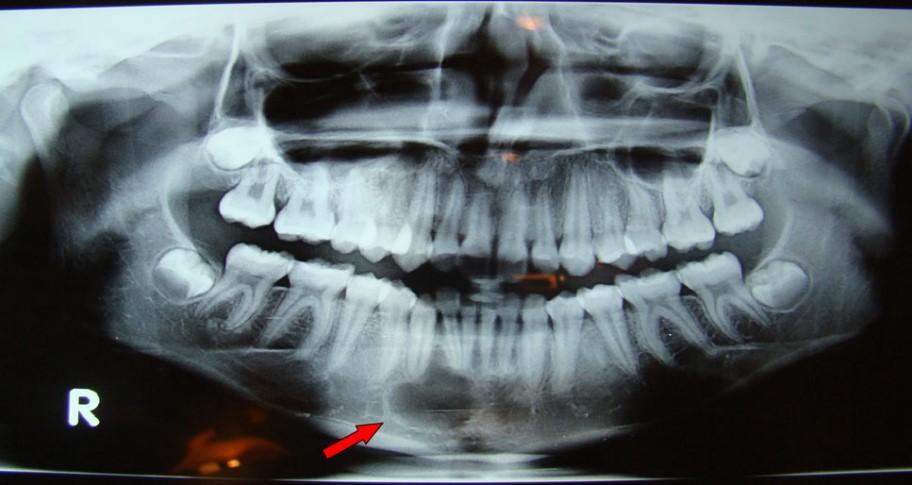 28 KUVA 13 Traumaattinen luukysta (45) Periapikaalinen sementtidysplasia on harvinainen muutos hampaan juuren periapikaalialueella (kuva 14).