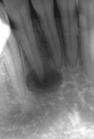 kirkastuma juuren kärjen ympärillä. Hampaat ovat vitaaleja ja lamina dura voidaan erottaa röntgenkuvasta.