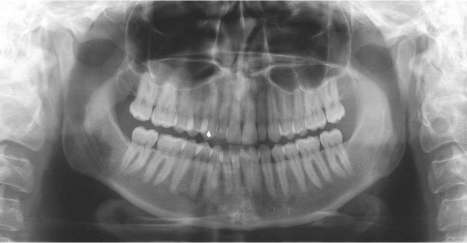 8 3.2 Panoraamaröntgenkuva Panoraamaröntgenkuvantamisesta on tullut suosittu ja tärkeä diagnostinen röntgentutkimus (13).