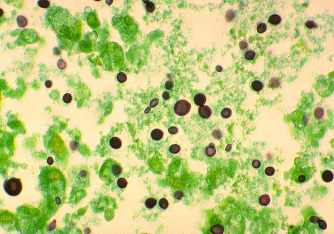 albicans Ituputki kandidat Infektiot Infektiolle altistavia tekijöita laajakirjoinen antibiootti perustauti vierasine iv-kanyylit GI-operaatiot/vammat A. Pinnalliset infektiot suun infektiot l.