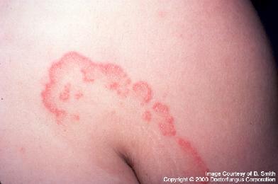 tonsurans (Pohjois-Amerikka) Tinea corporis (vartalon silsa) sieni-infektio