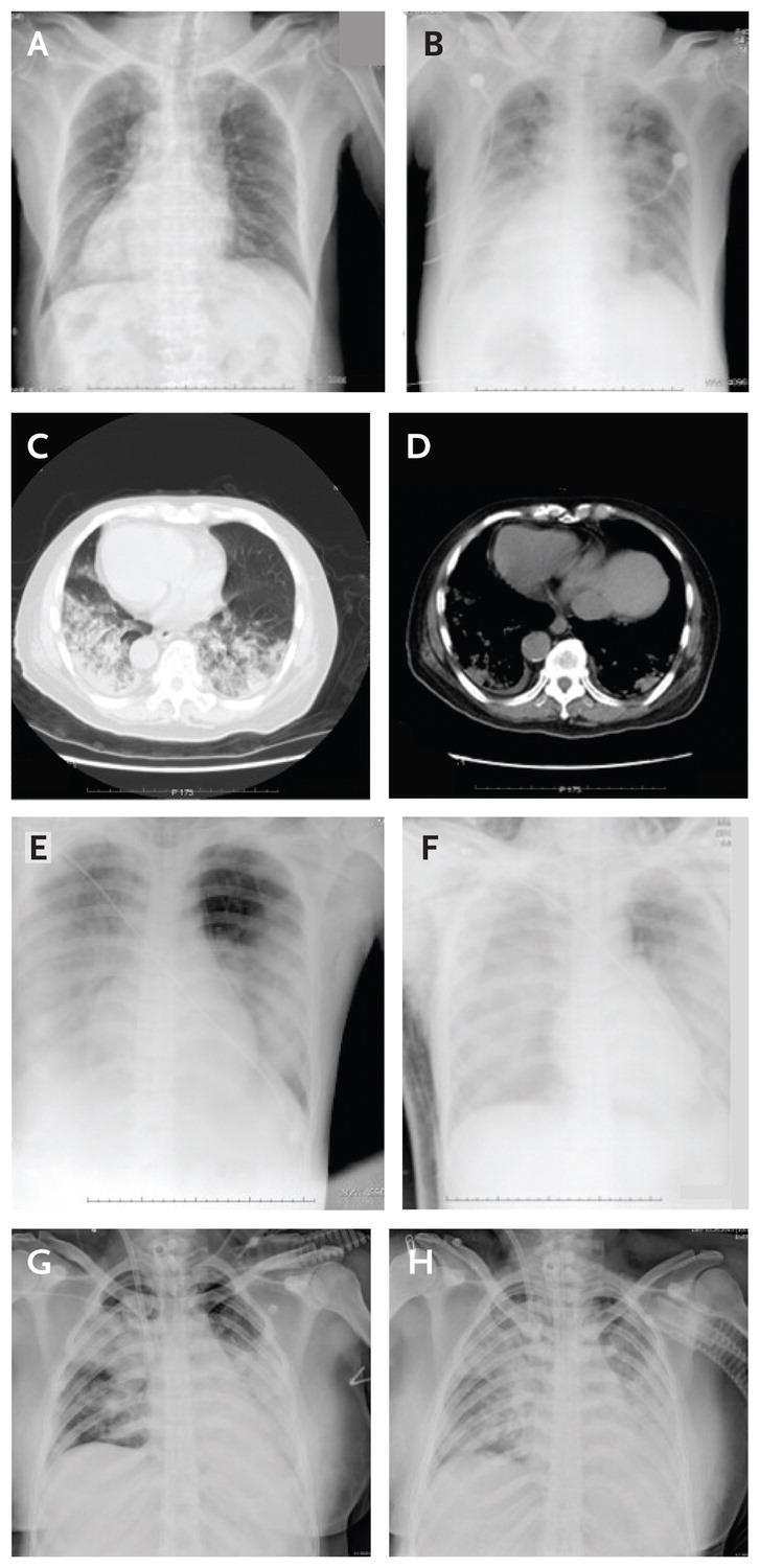 Chest Radiographs.