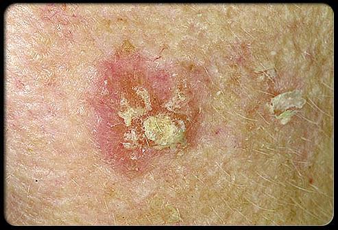 Basaliooma (tyvisolusyöpä, BCC) Yleisyys Tyvisolusyöpä eli basaliooma on yleisin kaikista pahanlaatuista ihokasvaimista.