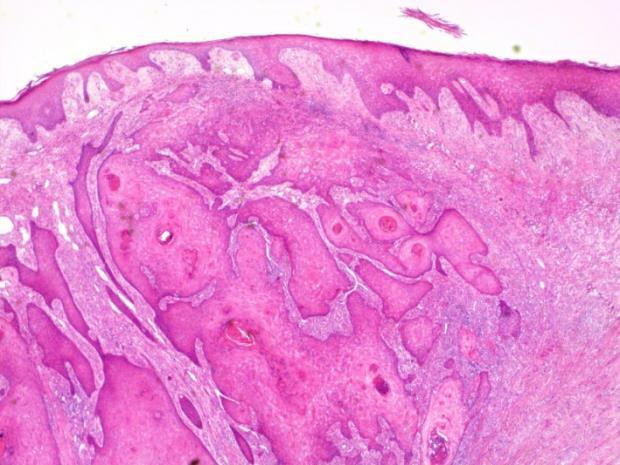 Tautia tavataan eniten iäkkäillä potilailla [18]. Syyt ja riskitekijät Kuten edellisissäkin ihosyövissä, myös tässäkin on auringon ultraviolettisäteilyllä suuri merkitys.