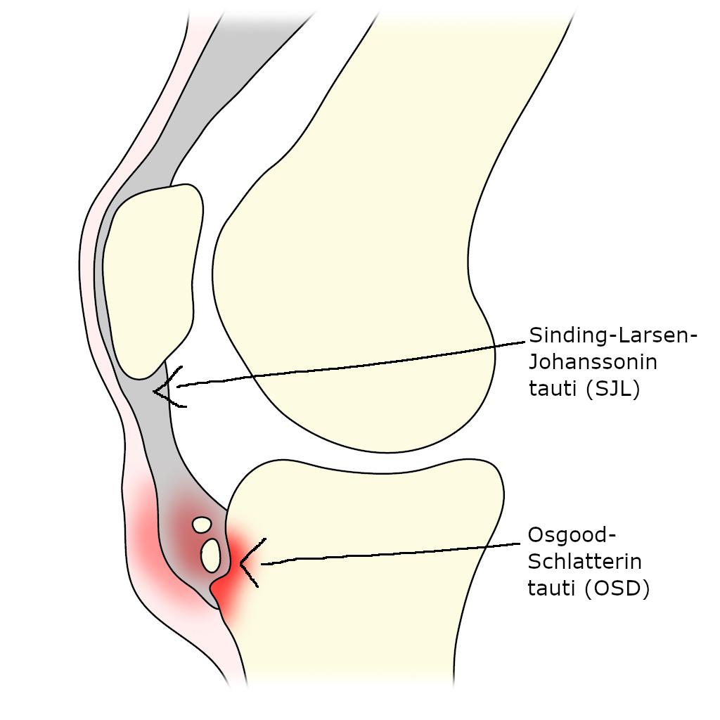 27 KUVA 8. SJL & OSD tautien sijainti (Muokattu Palsingh 2018) Osteochondritis dissecans on rustoluukuolio polvessa.