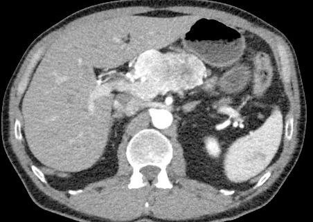 Case Rep Gastroenterol 2017;11:616 24. 10 Puolakkainen P, Kokkola A, Seppänen H. Haimakasvaimet. Kirjassa: Färkkilä M, Heikkinen M, Isoniemi H, Puolakkainen P, toim.