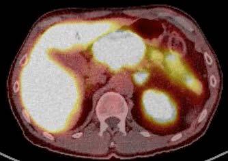 Establishment and verification of a scoring model for the differential diagnosis of pancreatic cancer and chronic pancreatitis. Pancreas 2018;47:459 65.