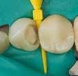 Epätäydellinen karieksen ekskavaatio, joka jättää affektoitunutta dentiiniä pulpaa paljastamatta. 3.