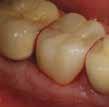 Puhdistettu ja preparoitu hammas. 2. TheraCem annosteltuna. 3. TheraCemin puhdistus. 4. Tarkistetut ienreunat. 1.