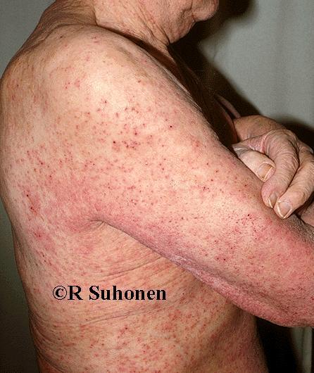 Karstasyyhy (Norwegian scabies, rupisyyhy) Laaja-alainen (joskus paikallinen) syyhyn muoto Immuunipuutteiset (esim.