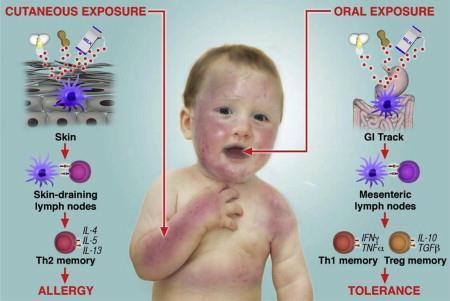 Varhainen ihoaltistuminen allerginen herkistyminen Varhainen per os altistuminen toleranssi