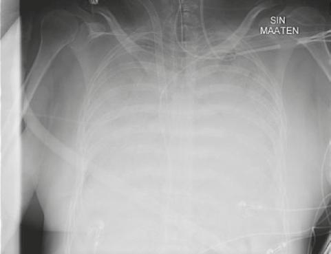 8 Pinsetti 2/2011 Keuhkonsiirrot ovat tulleet muiden elinsiirtojen rinnalle Pekka Hämmäinen LKT, erikoislääkäri Taustaa Ensimmäinen keuhkonsiirto tehtiin jo vuonna 1963 Yhdysvalloissa, mutta