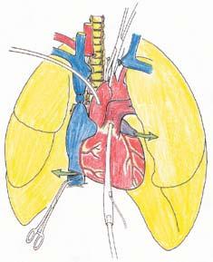 Pinsetti 2/2011 9 Kuva 3. Sydän ja keuhkot jäähdytetään ja suojataan aortan tyven ja keuhkovaltimon kautta kylmillä liuoksilla.