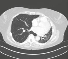 Luovuttajan ja vastaanottajan kokoepäsuhtaa voidaan tasapainottaa pienentämällä kirurgisesti luovuttajan keuhkoa (Kuva 4).