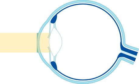 TAITTUMISVIRHEET JA NÄKÖHÄIRIÖT Sarveiskalvon optinen teho määrittää kuvan keskipisteen tarkkuuden silmämme filminauhalla.